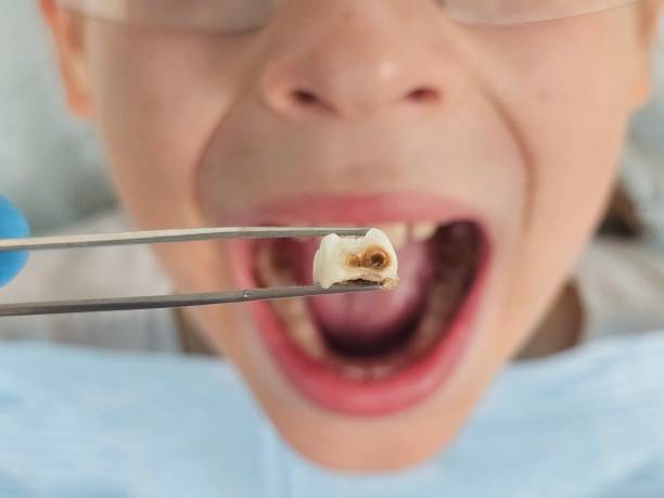 Best Emergency Dentist for Knocked-Out Tooth in Byron, GA